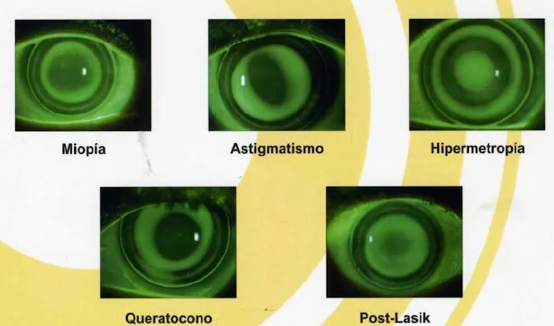 Prótesis Oculares Ocampo - Optometrista en Madrid - foto 2